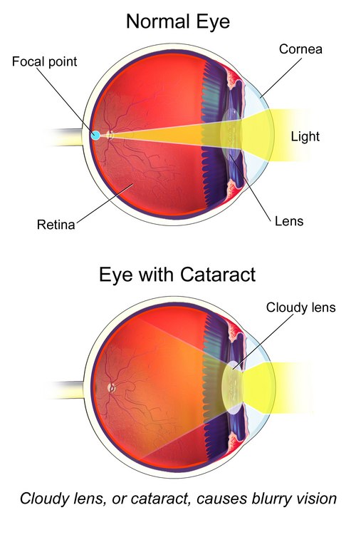 June is Cataracts Awareness Month!